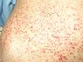 Image displaying example of angiokeratoma