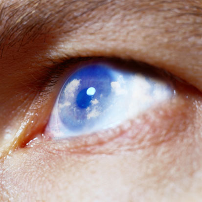 Cornea Opacity